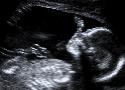 20130417 ultrasound1