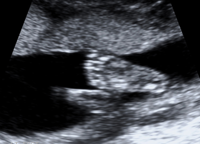 20130417 ultrasound3